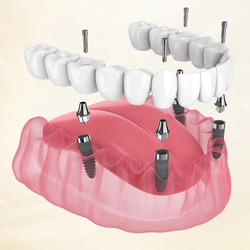 Giá implant Hàn Quốc thường tối ưu hơn so với các dòng trụ từ châu Âu hay Mỹ